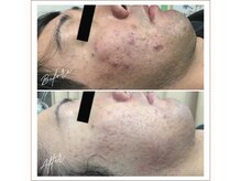 ミューベル(MYubelle)/【メンズニキビケア】水光ピール