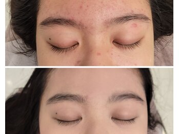 北原美顔/10代女性/ニキビケア