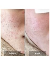 モカ 天王寺店(MOKA)/剥離3回　ホホニキビ　ハーブ