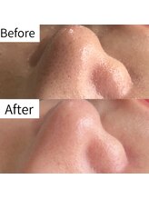 ヒカリエステ 六本木(HIKARI ESTHE)/ハイドラ＋ピーリング＋美容液