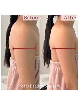 Blossom 【ホワイトニング/脱毛/韓国肌管理/毛穴洗浄】【3/23 NEW OPEN(予定)】/REDSHOT　二の腕