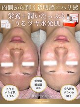 ソユ(SOYOU)/施術* &nbsp;&nbsp;&nbsp;&nbsp;&nbsp;&nbsp;&nbsp;ララピール