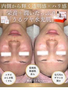 ソユ(SOYOU)/施術* ララピール