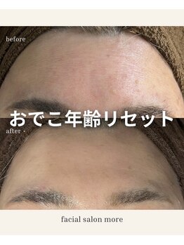 ヨサ モア(yosa more)/【40代額小ジワ】BeforeAfter