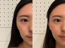 アム(aM)の雰囲気（自然な立体感のあるフェイスラインに。4本で変化を出す美容鍼）