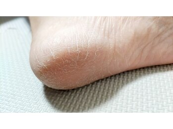 ソラ(sora)/加齢によって新陳代謝が低下!