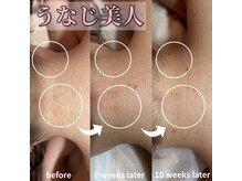 サロン(SALON)/うなじ脱毛