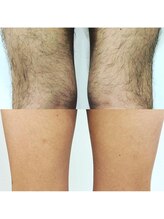 エリクサー 熊谷店(Elixir)/メンズ全身脱毛OK！部分脱毛OK！