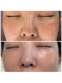 ピュア 川越店/光フェイシャル