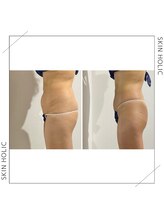 スキンホリック 恵比寿駅前店(SKIN HOLIC)/全身☆痩身ビフォア＆アフター★