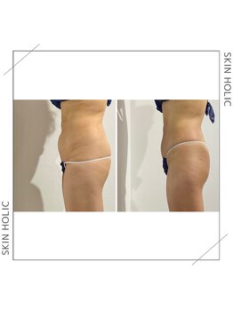 スキンホリック 恵比寿駅前店(SKIN HOLIC)/全身☆痩身ビフォア＆アフター★