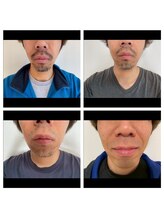 ビークラン(BecraN)/ヒゲ脱毛！