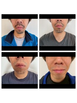 ビークラン(BecraN)/ヒゲ脱毛！