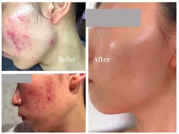 ヴィヴァンビー(Vivant+B)/before /after