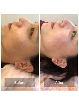 爽健美/美容鍼効果