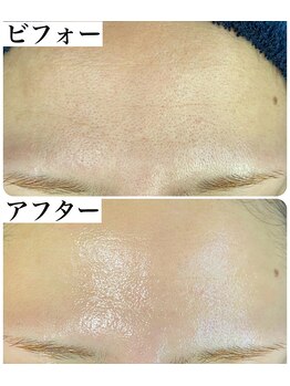 スティーン(Styin)/顔ワックスで毛穴ケア【京丹後】