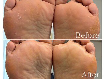 カシェット 広島店(Cachette)/50代女性☆足裏角質ケア90分