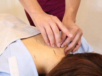 上尾メディケア整骨院 鍼灸院の写真/コリ改善に特化した鍼施術＋全身整体￥5500が人気★凝り固まった筋肉を刺激＆体の歪み改善で楽な身体に◎