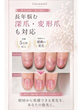 ティアラネイル 宇都宮&nbsp;栃木県初！ 深爪矯正