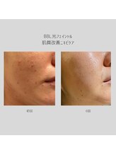 エモベーシック(e'MO BASIC)/BBL光フェイシャル　ニキビケア