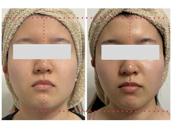 美バストアルファ(美bust α)/【小顔コルギ】症例