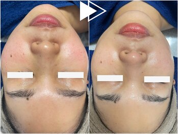 リシェス(Richesse)/毛穴ケアハーブ初回¥9990