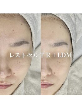 イロハ(IROHA)/レストセルトリートメント+LDM