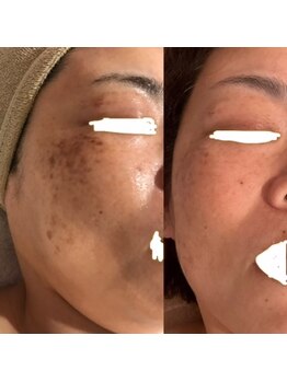 ブリスルーチェ(Bliss luce)/【肌質根本改善】