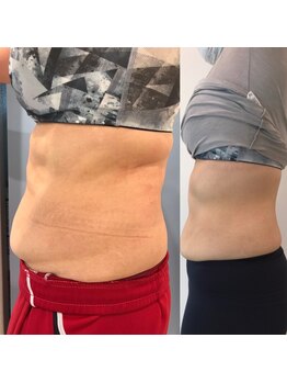 ブリスルーチェ(Bliss luce)/【痩身】マグニート