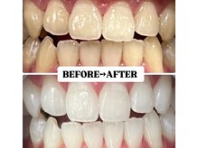ホワイトニングサロン 豊中/Before&After美白ホワイトニング