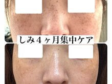 ♯くすみ　♯美白　♯毛穴　♯しみ　♯シミ　♯ピーリング