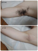 キナリ(kinari)/ワキのダブル脱毛