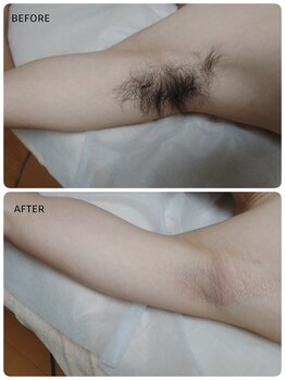 キナリ(kinari)/ワキのダブル脱毛