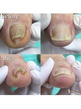 巻き爪補正店　豊橋店【巻き爪・魚の目・角質・副爪】【5月上旬オープン（予定）】/巻き爪