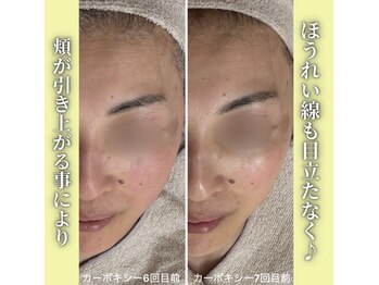 ハニエル(Haniel)/カーボキシー症例