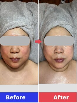 ブルームオーラ 月(BLOOM AURA)/驚きのIPS最高峰フェイシャル!