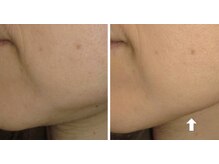 ビューティースパ/顔のたるみにアプローチ！