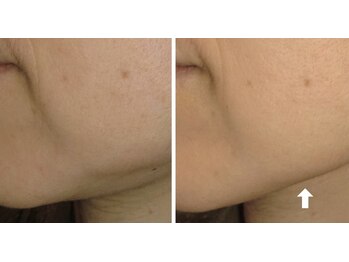 ビューティースパ/顔のたるみにアプローチ！