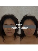ウーマンビーヘルス(woman Be Health)/美容鍼灸　Before　After
