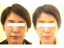 サロンドエステケイワイ(de KY)/フェイシャル☆小顔、タルミ改善