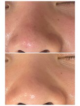 グリンプラス(grin+)/ハーブ/桂駅/フェイシャル