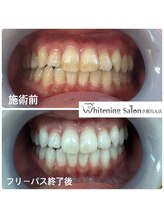ホワイトニングサロン 京都烏丸店/ホワイトニング施術例