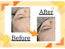 アルゴ 西鉄香椎駅前店(ALGO)/キッズ脱毛♪