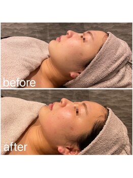 ビュウナ 銀座(BEAUNA)/カルテットモード全顔