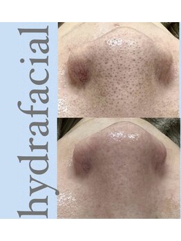 ヴィアージュ/◆最新の毛穴洗浄エステ ¥8800