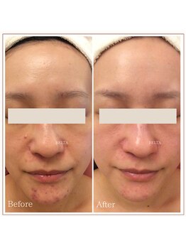 ベルタ 仙台店(BELTA)/【ケア前→後】