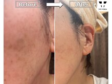 エヌ スタイル(N Style)/シミ改善