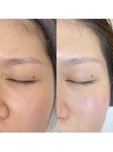 オパール 大阪梅田(op_l)/大阪/毛穴洗浄/フェイスワックス