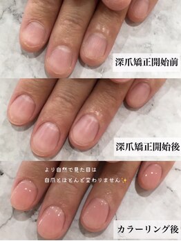 リファーレ(RIFARE)/【深爪矯正初回】長さ出し有◎