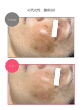 ボータン 恵(Beau Temps)/ウルトラ光トーニング/シミ改善